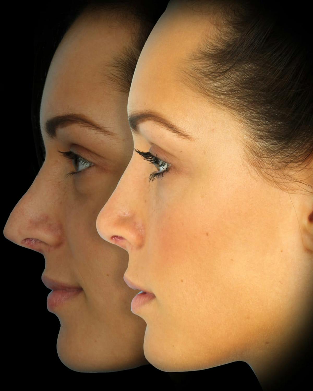Rhinoplasty Before & After Gallery - Patient 371818 - Image 3