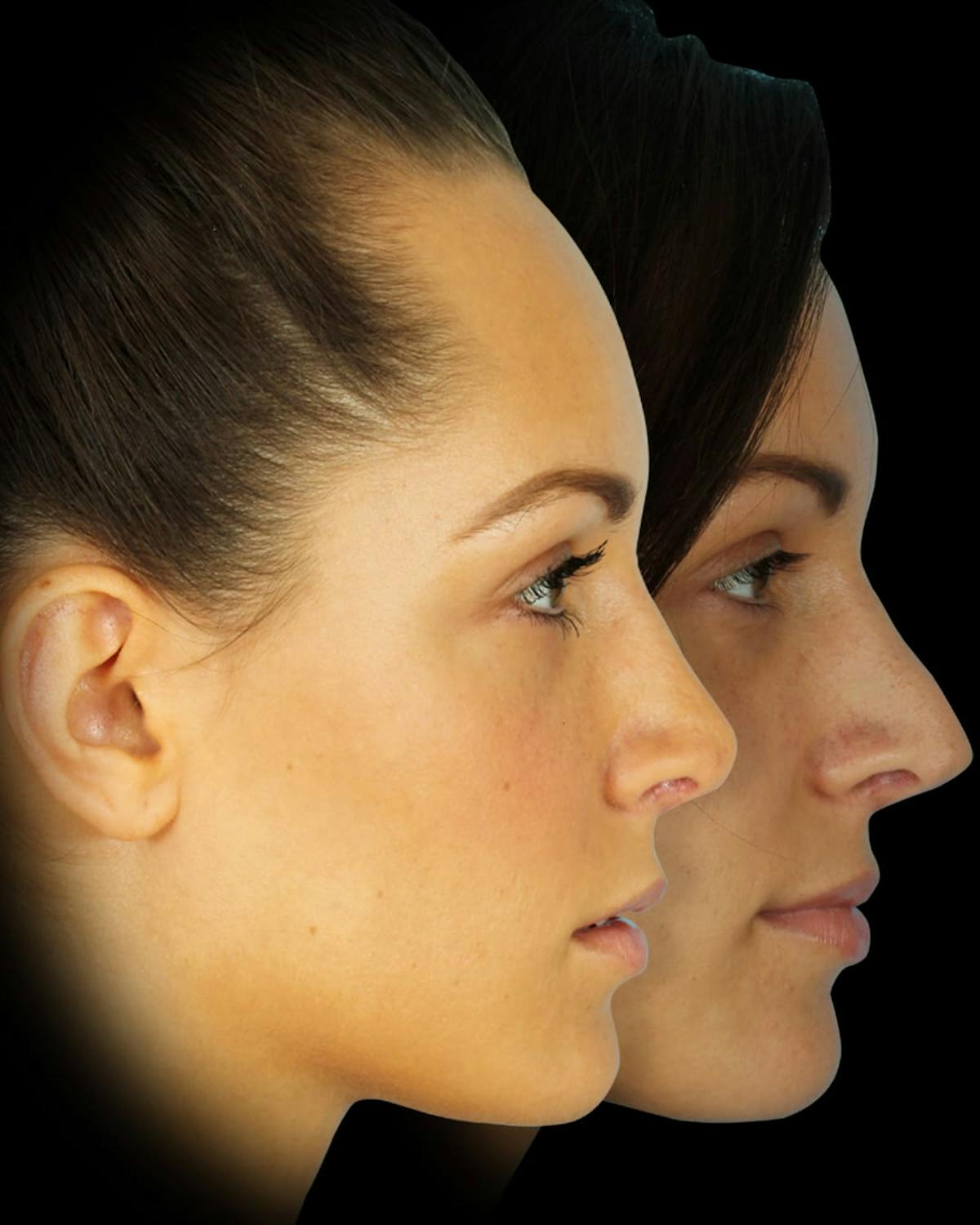 Rhinoplasty Before & After Gallery - Patient 371818 - Image 4