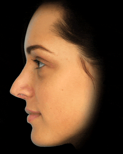 Rhinoplasty Before & After Gallery - Patient 371818 - Image 1