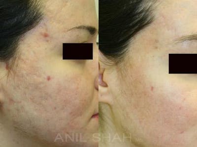 Acne Scars Before & After Gallery - Patient 361431 - Image 1