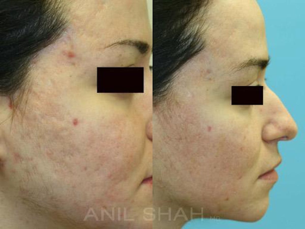 Acne Scars Before & After Gallery - Patient 361431 - Image 2