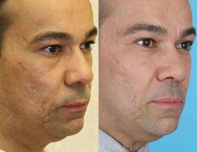 Acne Scars Before & After Gallery - Patient 766880 - Image 1
