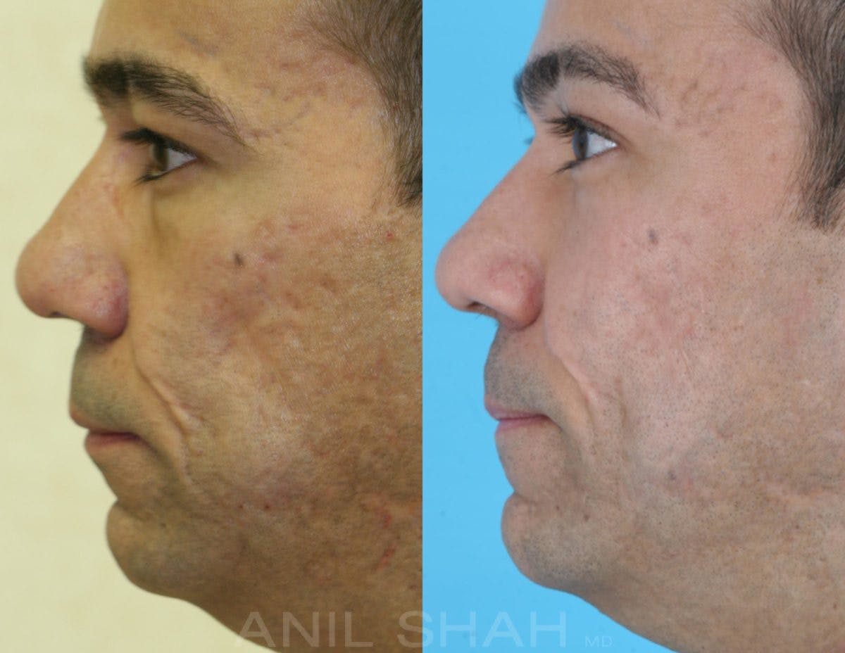 Acne Scars Before & After Gallery - Patient 766880 - Image 2