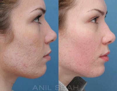Acne Scars Before & After Gallery - Patient 124961 - Image 1