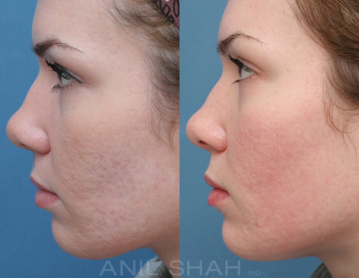 Acne Scars Before & After Gallery - Patient 124961 - Image 2