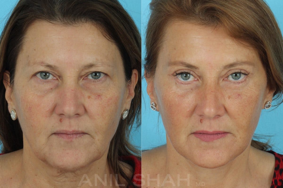 Aging Face Before & After Gallery - Patient 197788 - Image 1