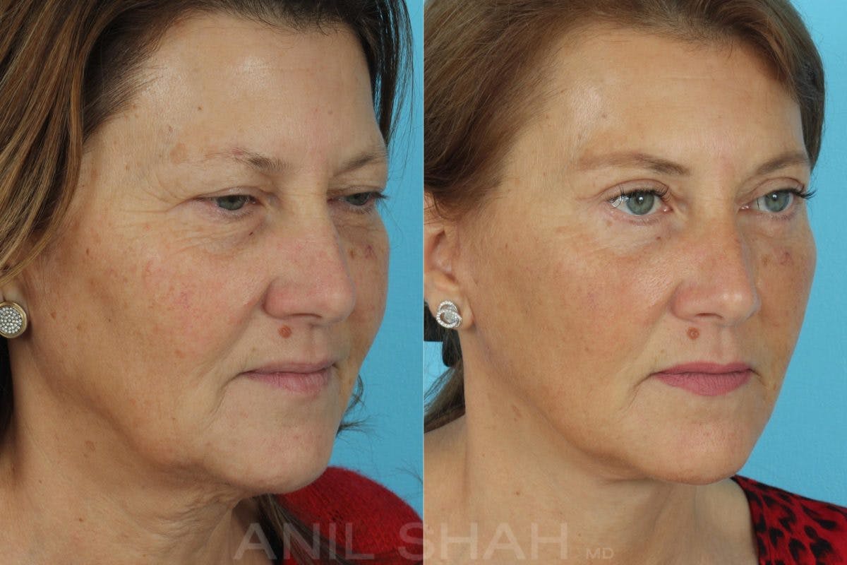Aging Face Before & After Gallery - Patient 197788 - Image 2