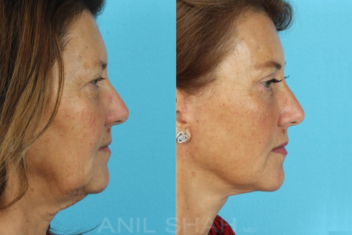 Aging Face Before & After Gallery - Patient 197788 - Image 3