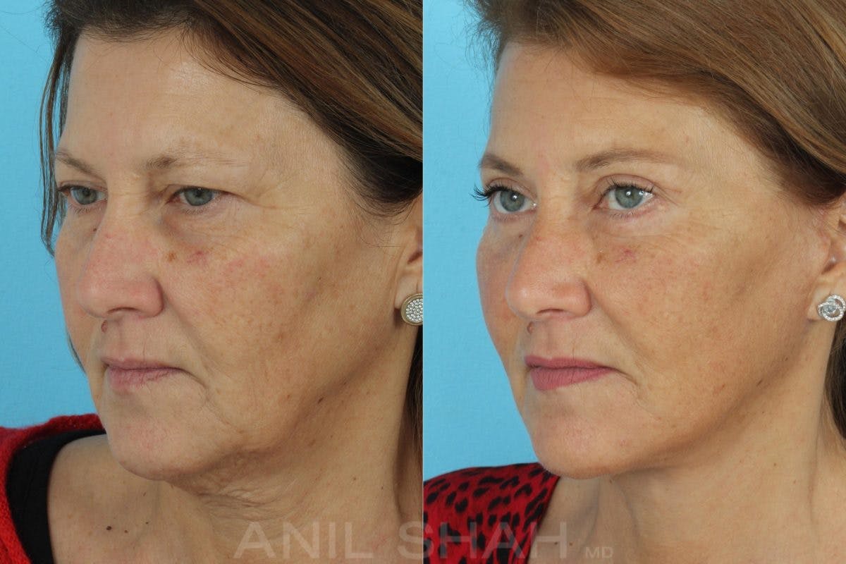 Aging Face Before & After Gallery - Patient 197788 - Image 4