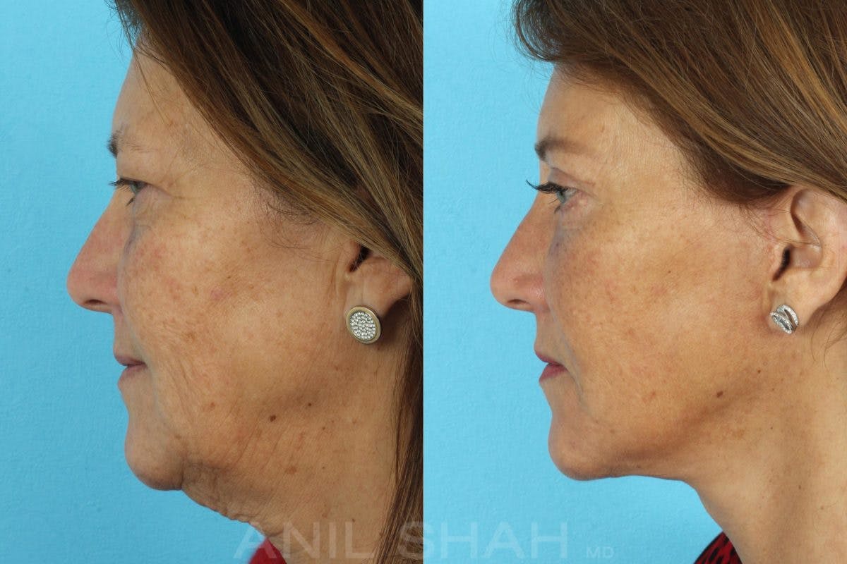 Aging Face Before & After Gallery - Patient 197788 - Image 5