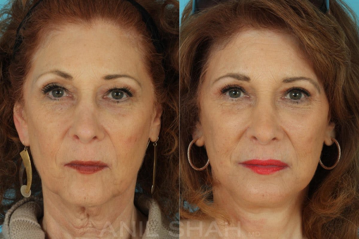 Aging Face Before & After Gallery - Patient 962233 - Image 1