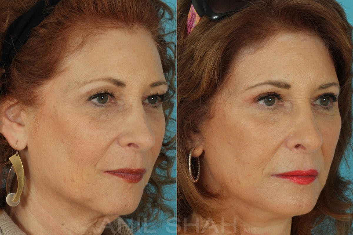 Aging Face Before & After Gallery - Patient 962233 - Image 2