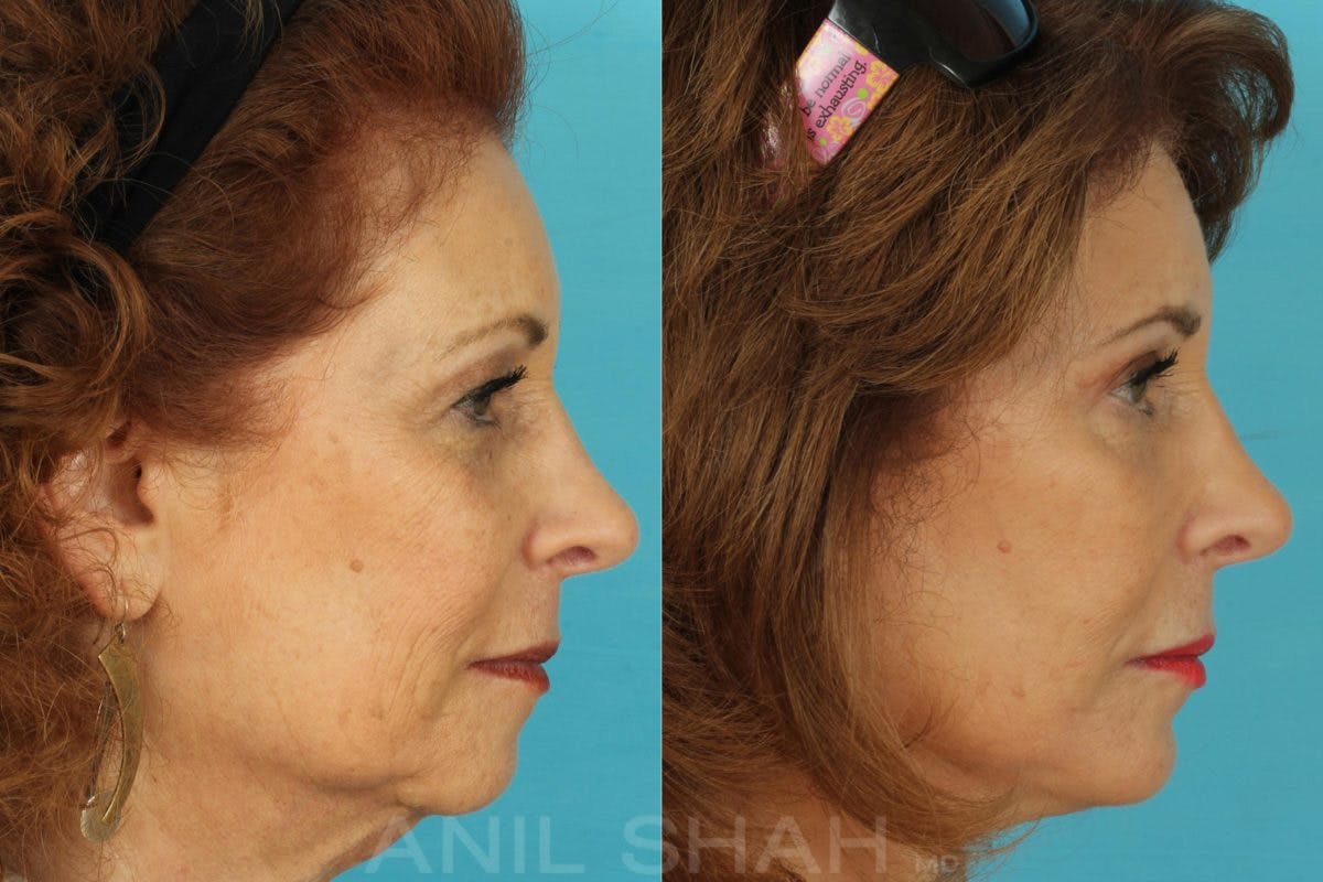 Aging Face Before & After Gallery - Patient 962233 - Image 3