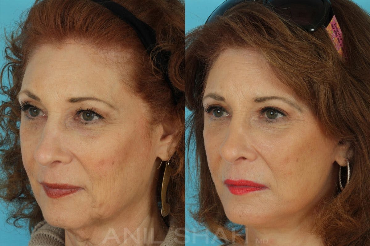 Aging Face Before & After Gallery - Patient 962233 - Image 4