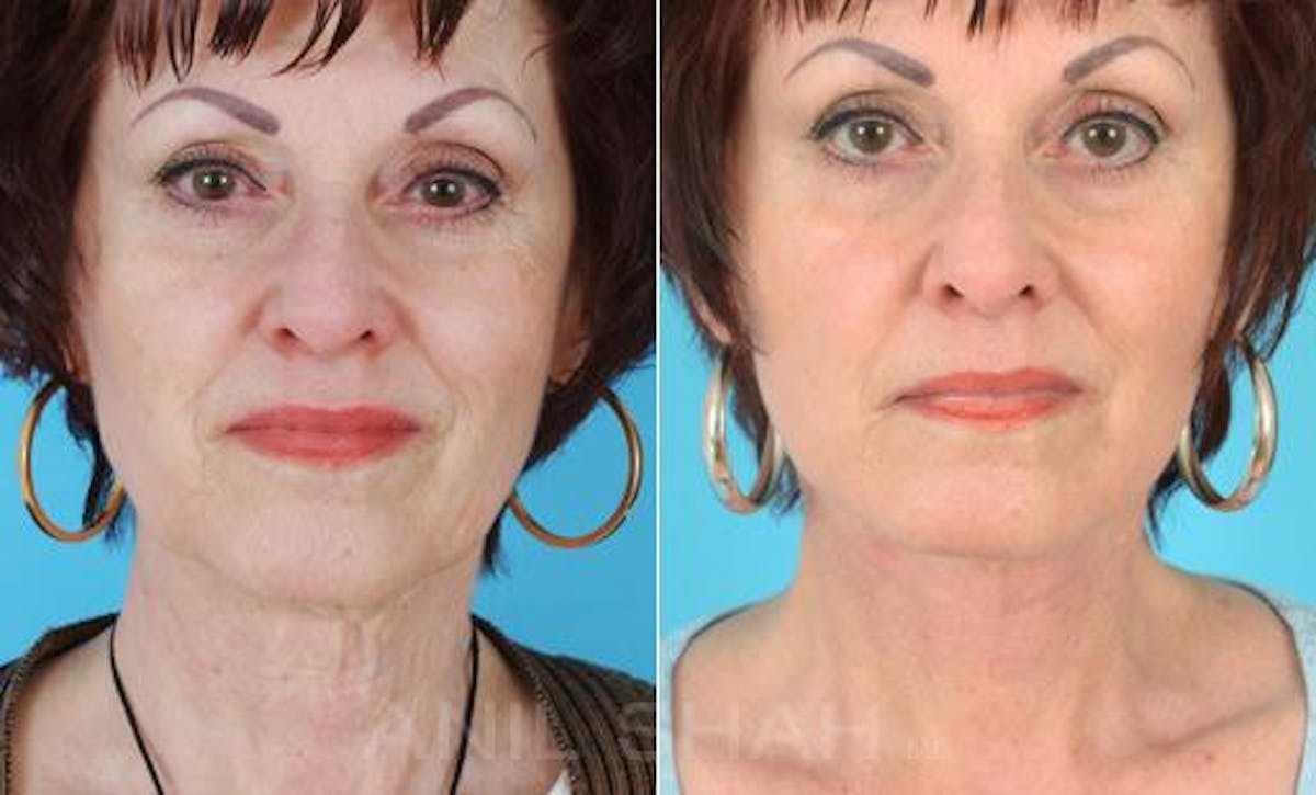 Aging Face Before & After Gallery - Patient 429257 - Image 1