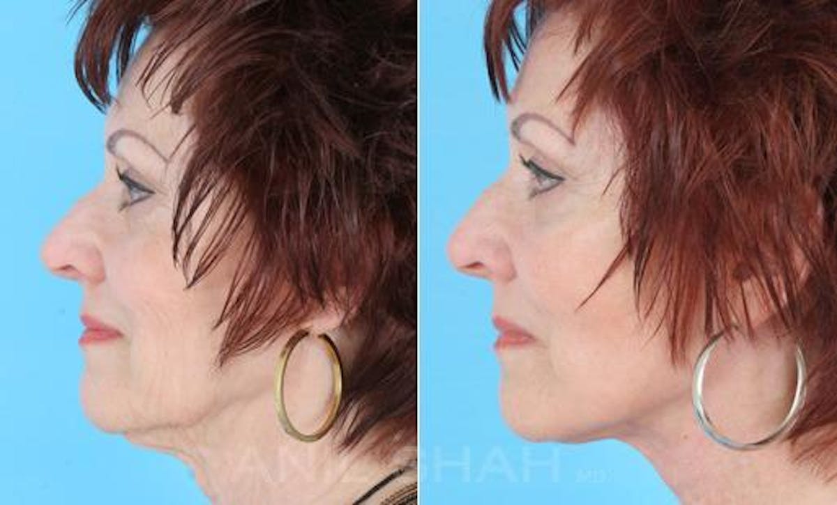 Aging Face Before & After Gallery - Patient 429257 - Image 2