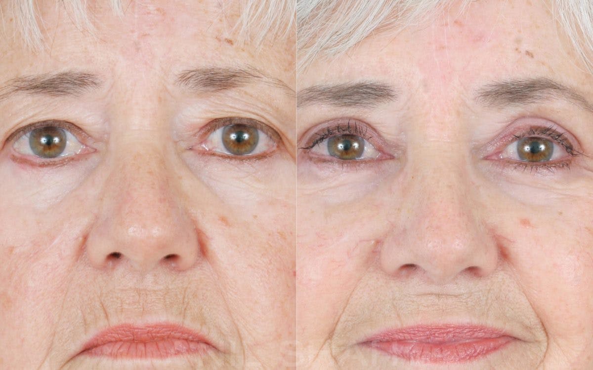 Aging Face Before & After Gallery - Patient 213859 - Image 2