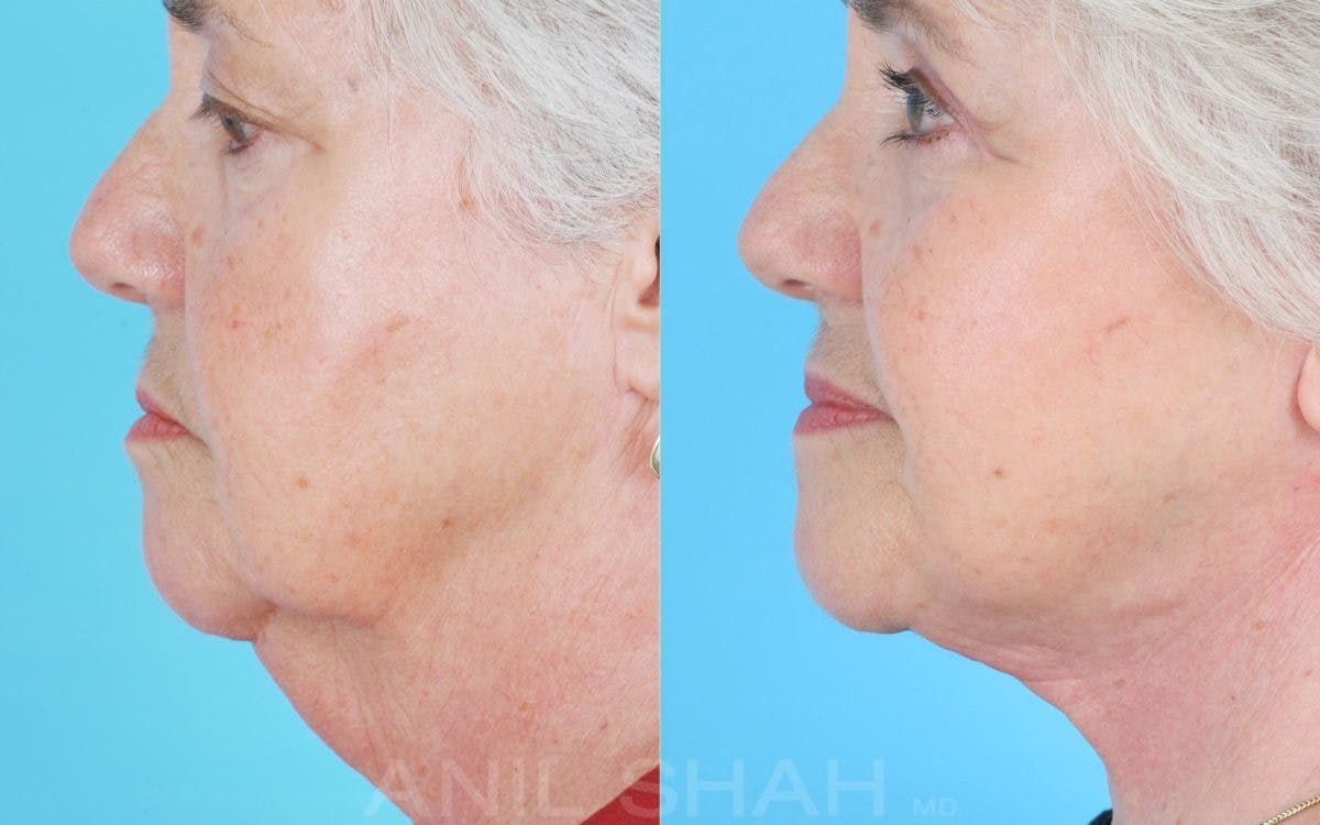 Aging Face Before & After Gallery - Patient 213859 - Image 3