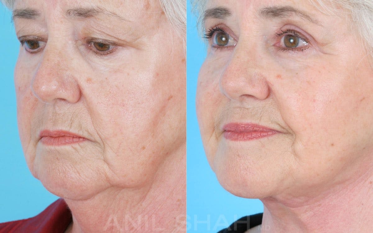 Aging Face Before & After Gallery - Patient 213859 - Image 4