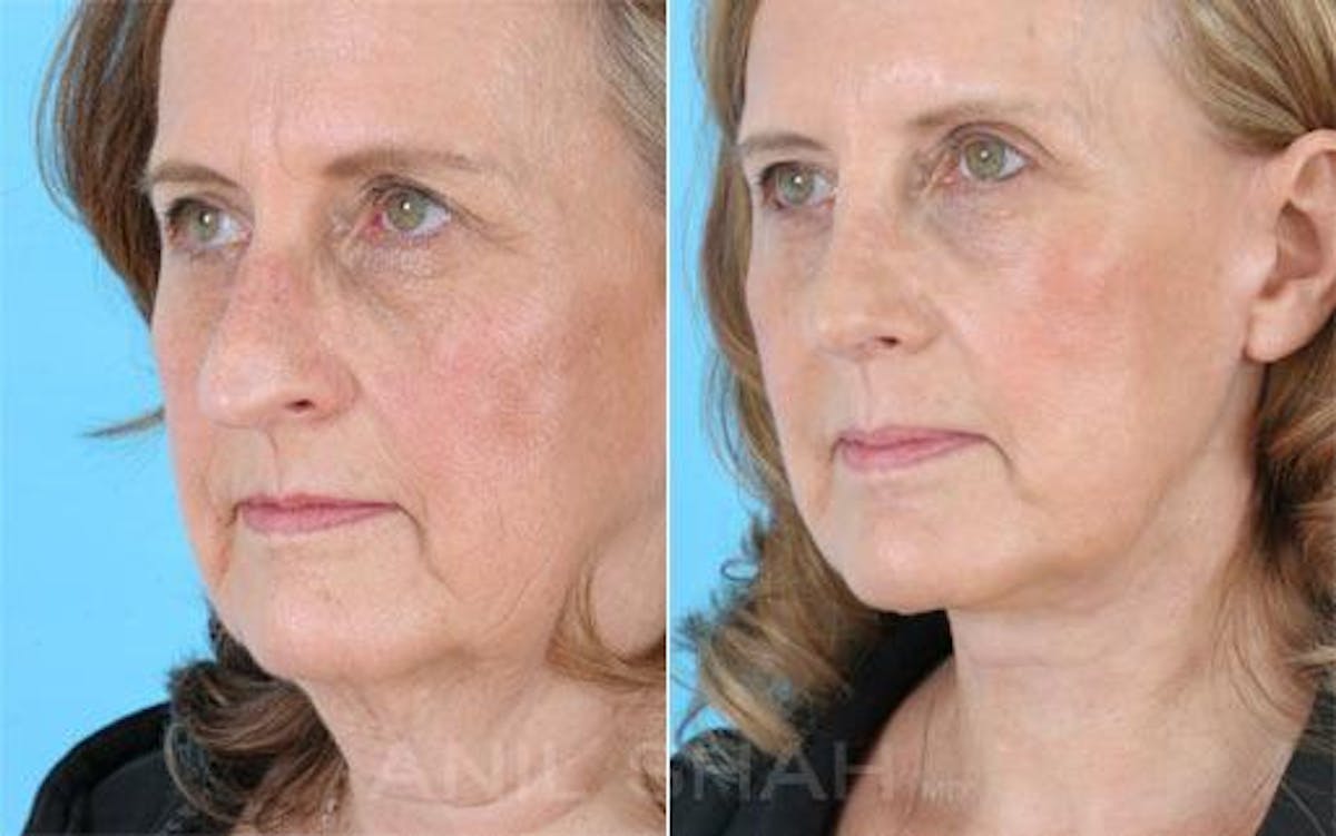 Aging Face Before & After Gallery - Patient 392710 - Image 1