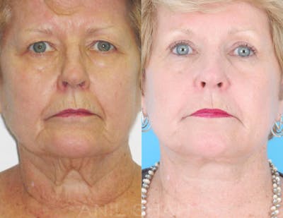 Aging Face Before & After Gallery - Patient 308234 - Image 1