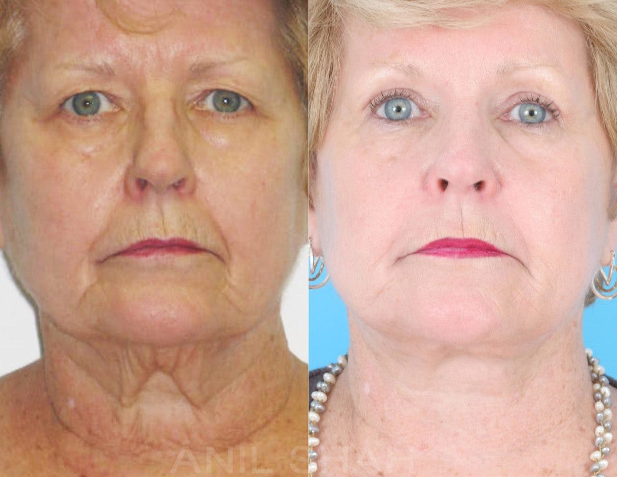 Aging Face Before & After Gallery - Patient 308234 - Image 1