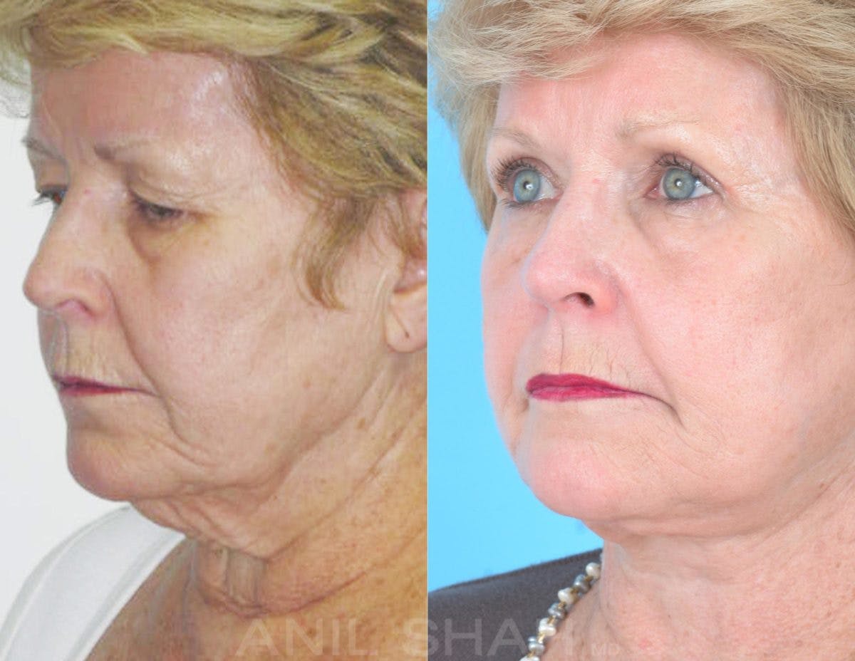 Aging Face Before & After Gallery - Patient 308234 - Image 2