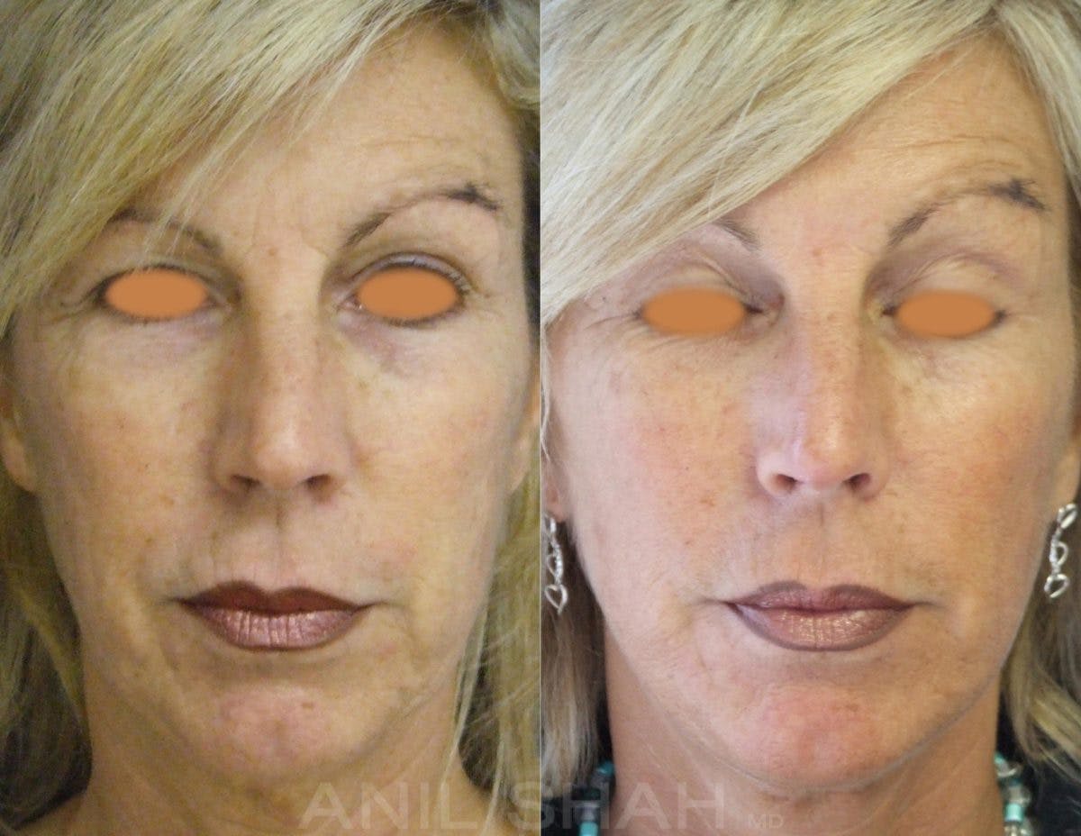 Aging Face Before & After Gallery - Patient 153193 - Image 1