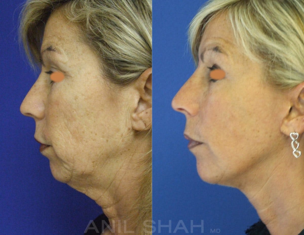 Aging Face Before & After Gallery - Patient 153193 - Image 2
