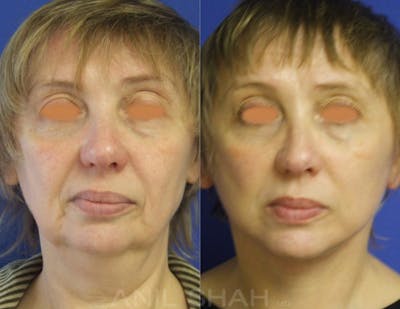 Aging Face Before & After Gallery - Patient 233523 - Image 1