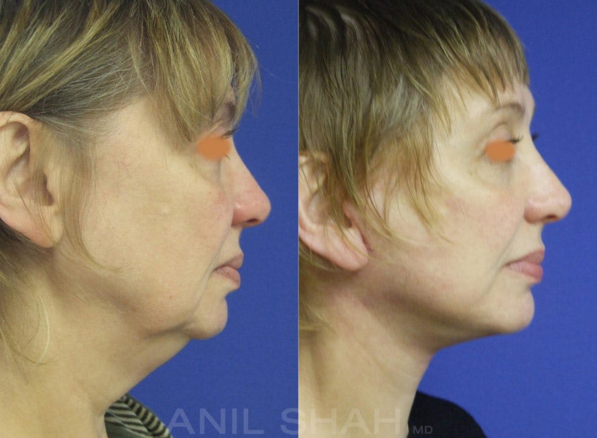Aging Face Before & After Gallery - Patient 233523 - Image 2
