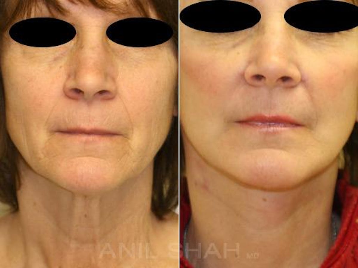 Aging Face Before & After Gallery - Patient 295843 - Image 1