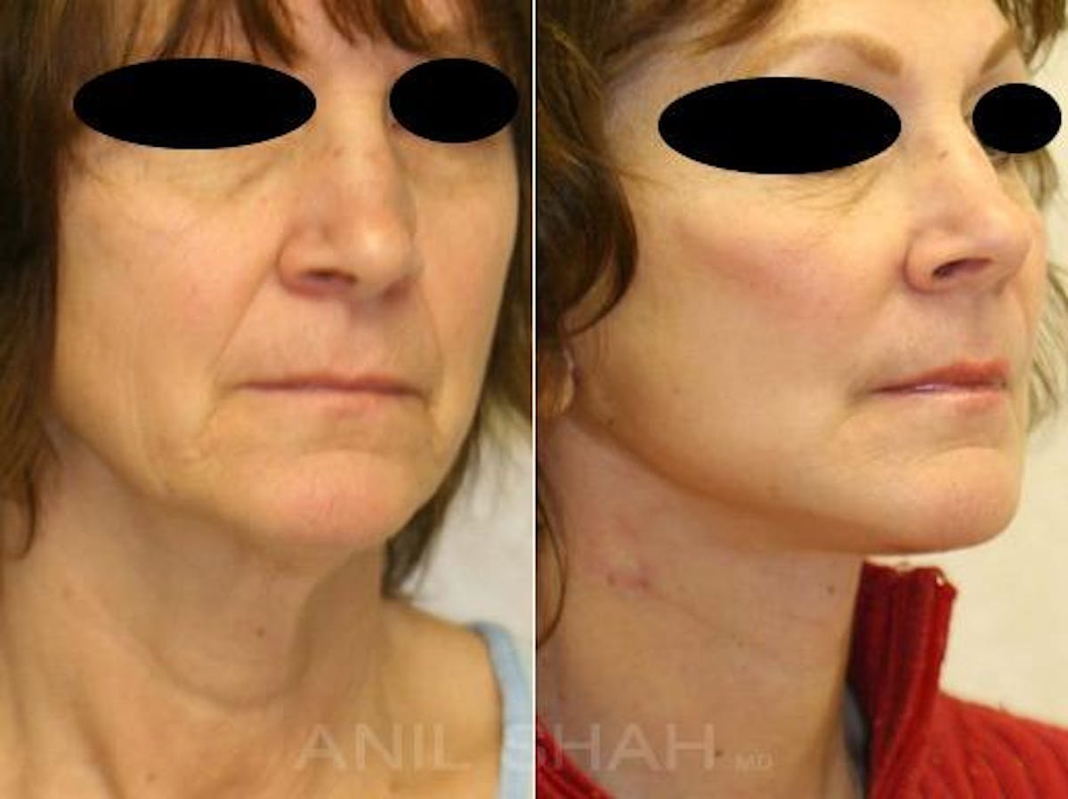 Aging Face Before & After Gallery - Patient 295843 - Image 2