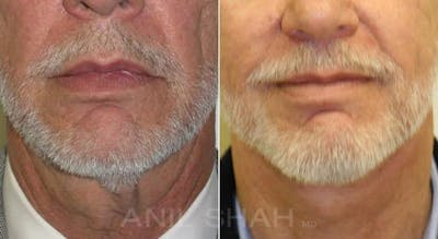 Aging Face Before & After Gallery - Patient 245028 - Image 1