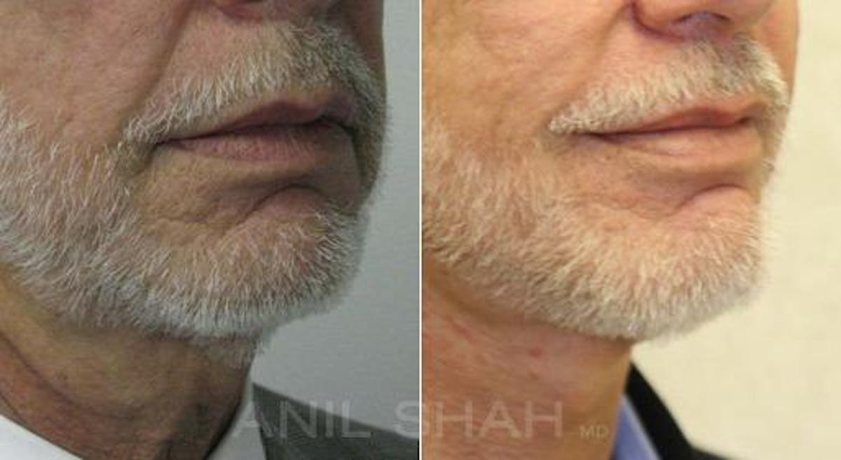 Aging Face Before & After Gallery - Patient 245028 - Image 2
