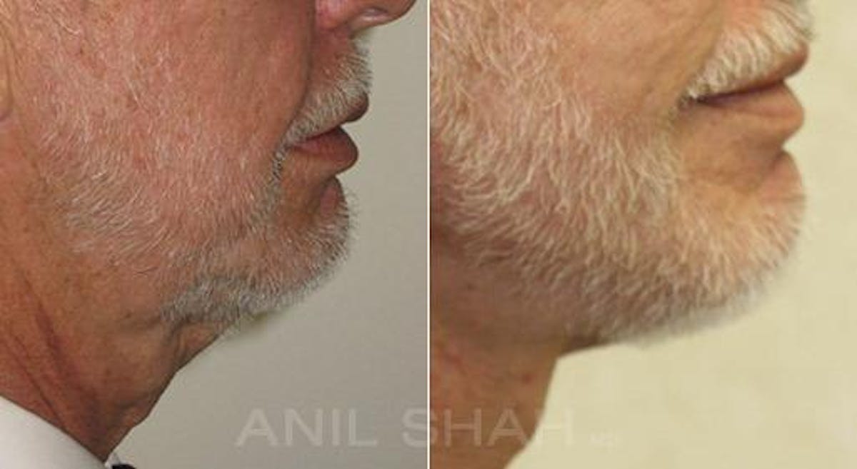 Aging Face Before & After Gallery - Patient 245028 - Image 3