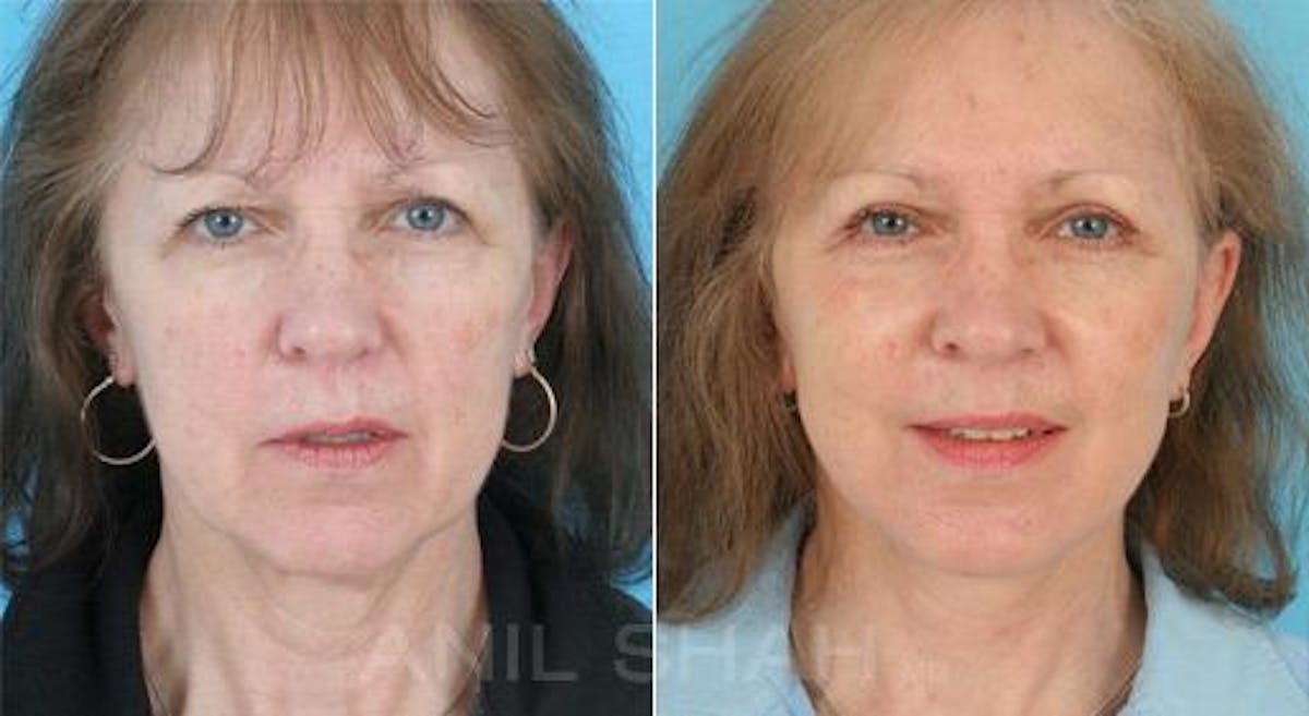 Aging Face Before & After Gallery - Patient 300143 - Image 1
