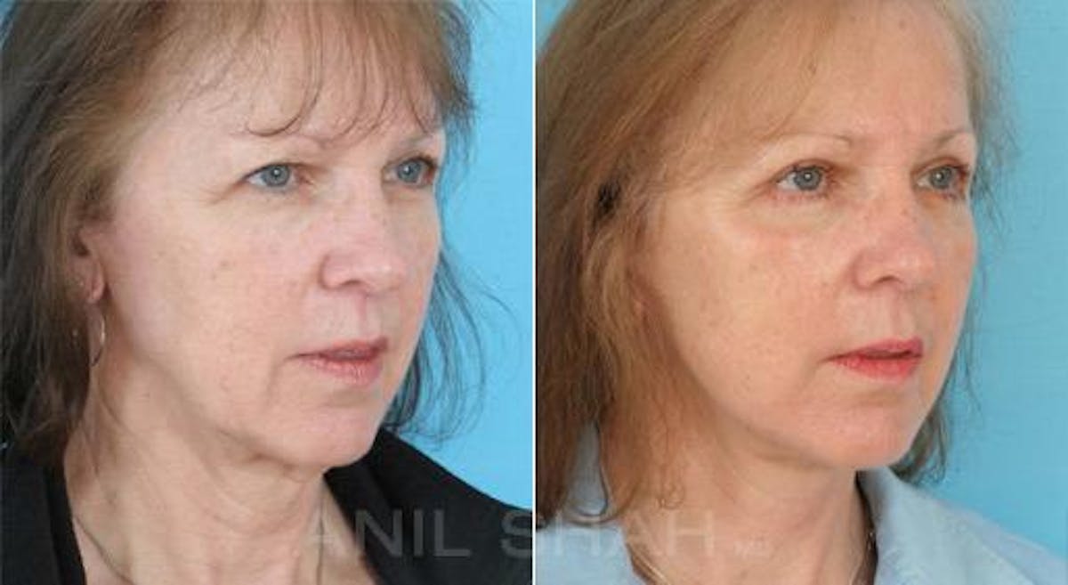 Aging Face Before & After Gallery - Patient 300143 - Image 2