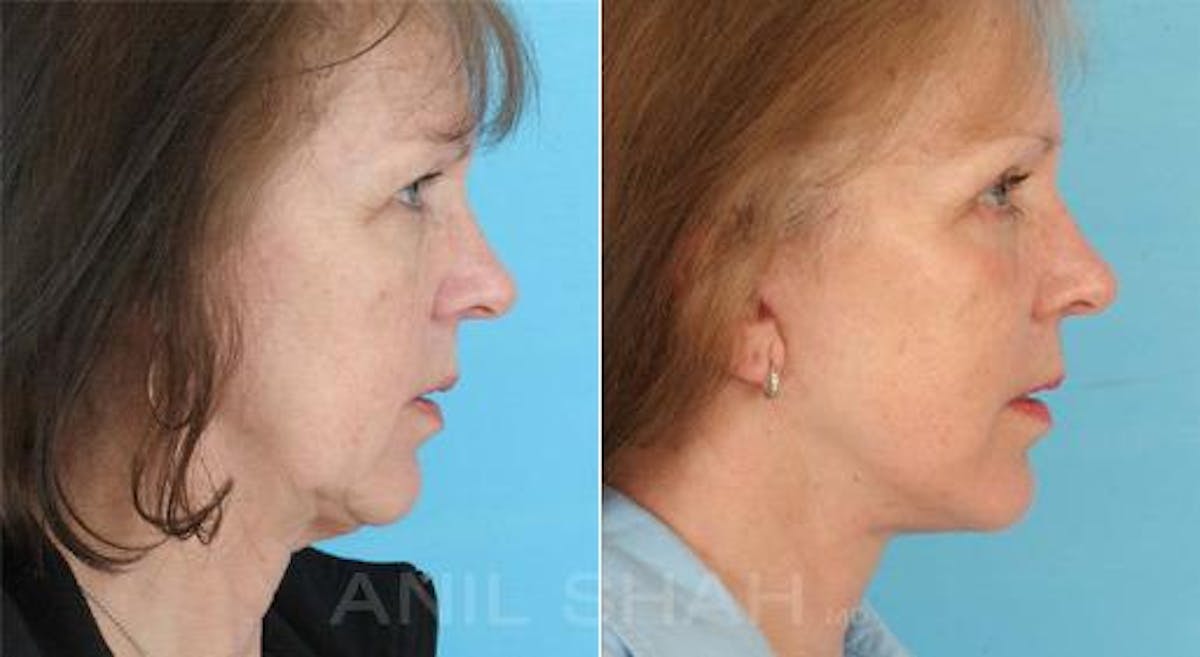 Aging Face Before & After Gallery - Patient 300143 - Image 3