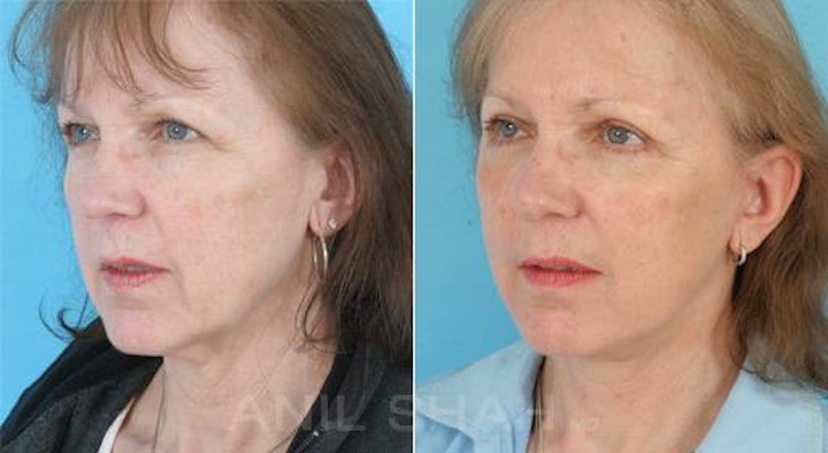 Aging Face Before & After Gallery - Patient 300143 - Image 4