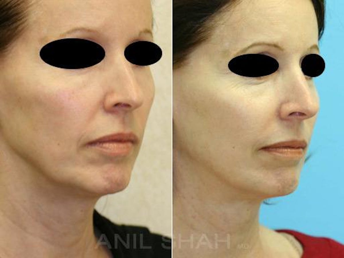 Aging Face Before & After Gallery - Patient 108942 - Image 1