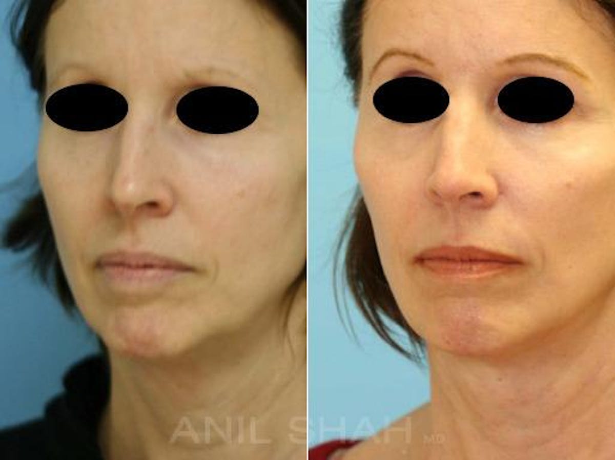 Aging Face Before & After Gallery - Patient 108942 - Image 2