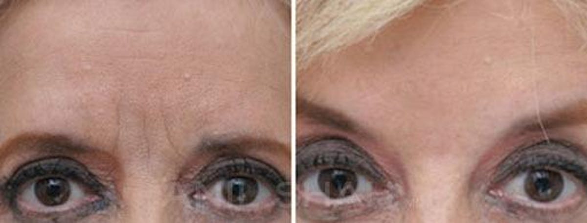 BOTOX Fillers Before & After Gallery - Patient 687409 - Image 1