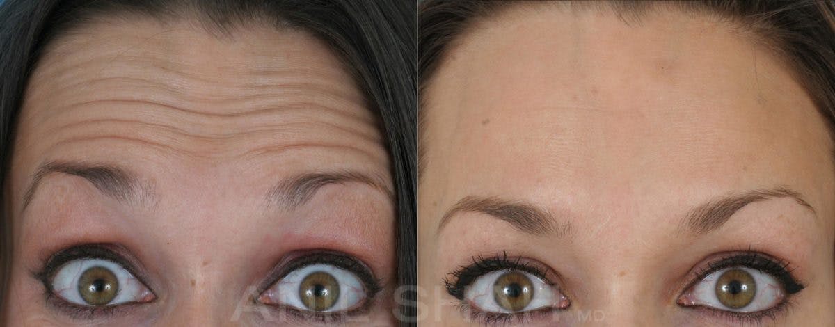 BOTOX Fillers Before & After Gallery - Patient 202985 - Image 1