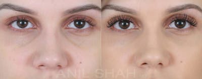 BOTOX Fillers Before & After Gallery - Patient 278395 - Image 1