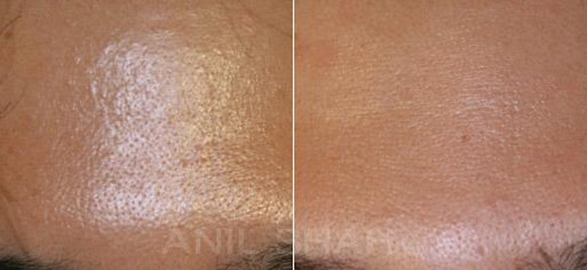 BOTOX Fillers Before & After Gallery - Patient 157181 - Image 1