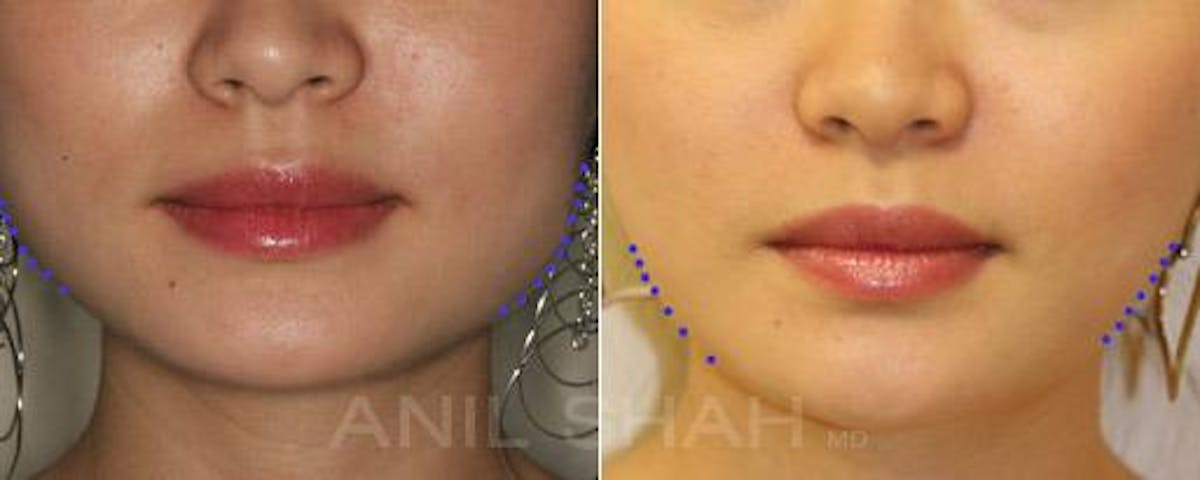 BOTOX Fillers Before & After Gallery - Patient 239184 - Image 3