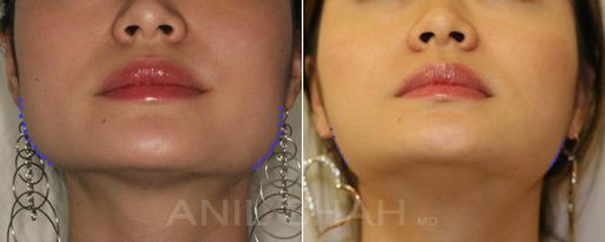 BOTOX Fillers Before & After Gallery - Patient 239184 - Image 4