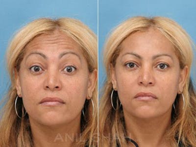 BOTOX Fillers Before & After Gallery - Patient 109683 - Image 1