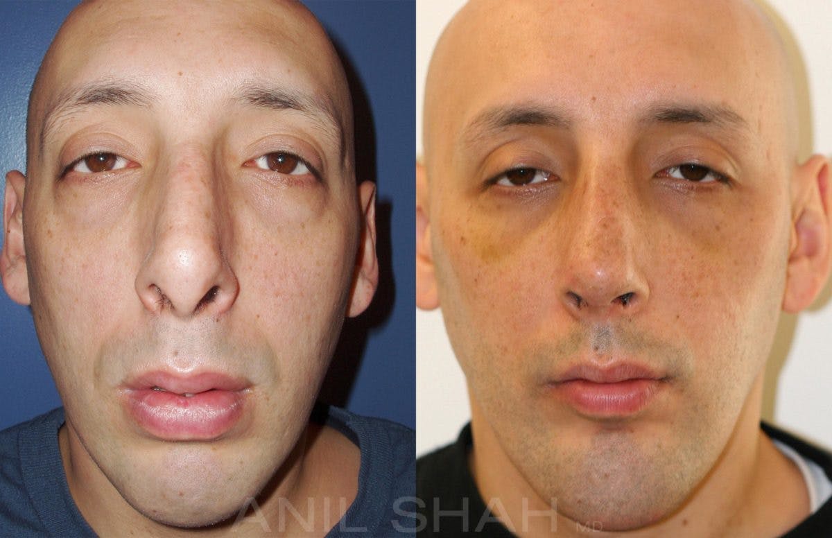 Facial Implants Before & After Gallery - Patient 383712 - Image 1